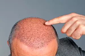 Researchers Say Baldness Could Increase Odds Of Prostate Cancer