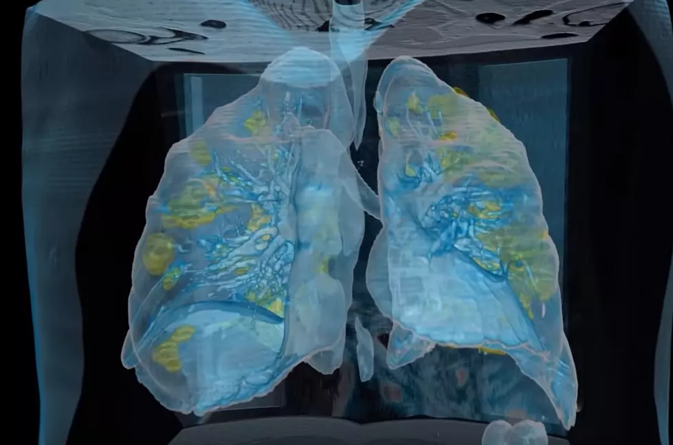 Video Of Covid-19's Effect On Your Lungs 