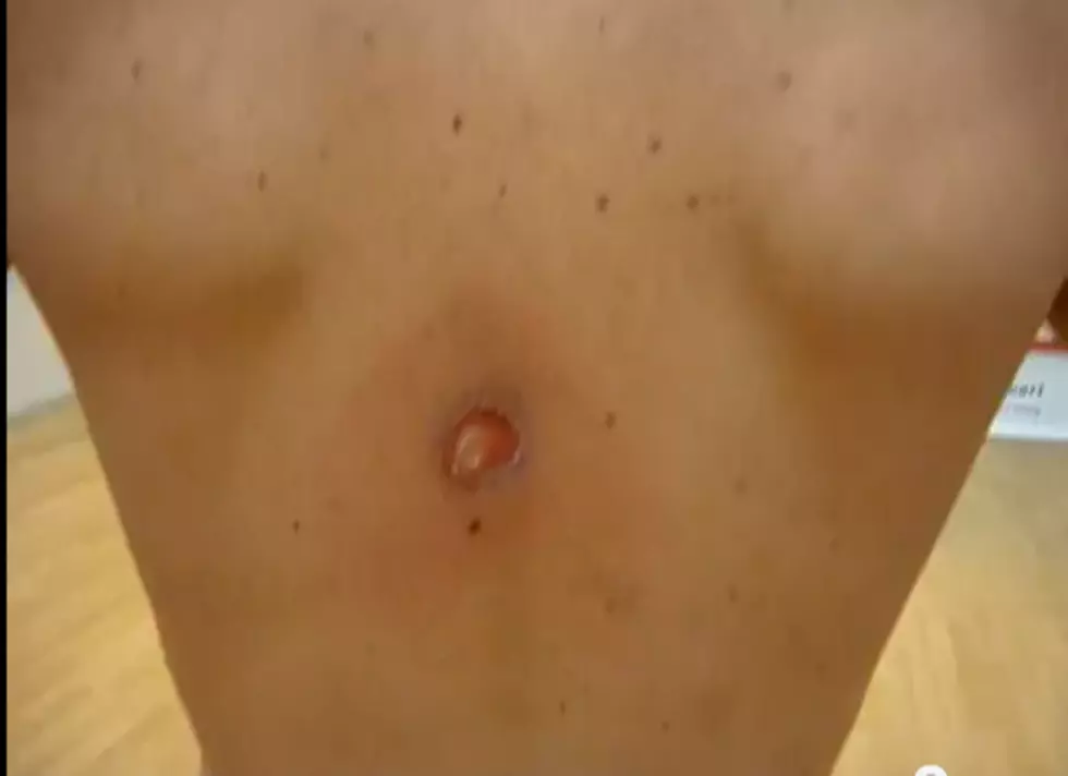 175 MPH Squash Ball Leaves Hole In Man&#8217;s Back