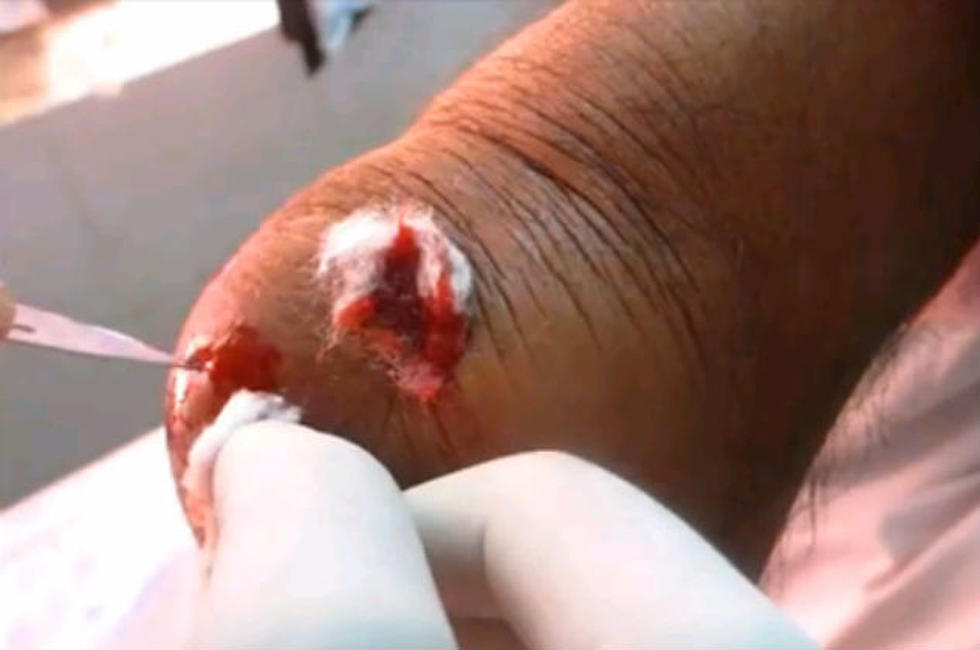The Drainage of a Large Abscess is the Grossest Thing On Youtube! [Video]