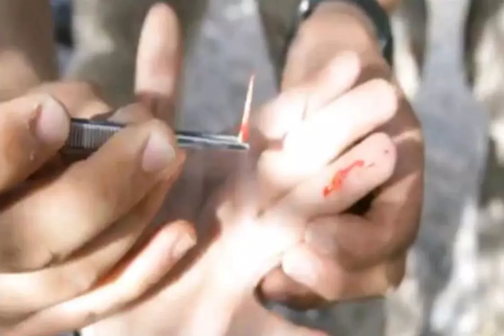 The Worst Splinter I Have Ever Seen! [Video]