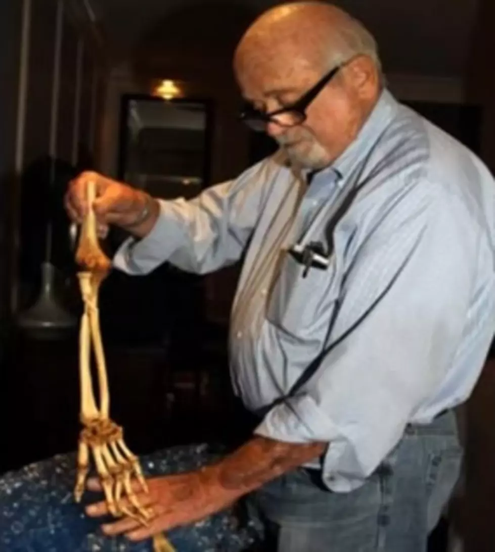 Amputee Reunited With His Arm 47 Years After Losing It