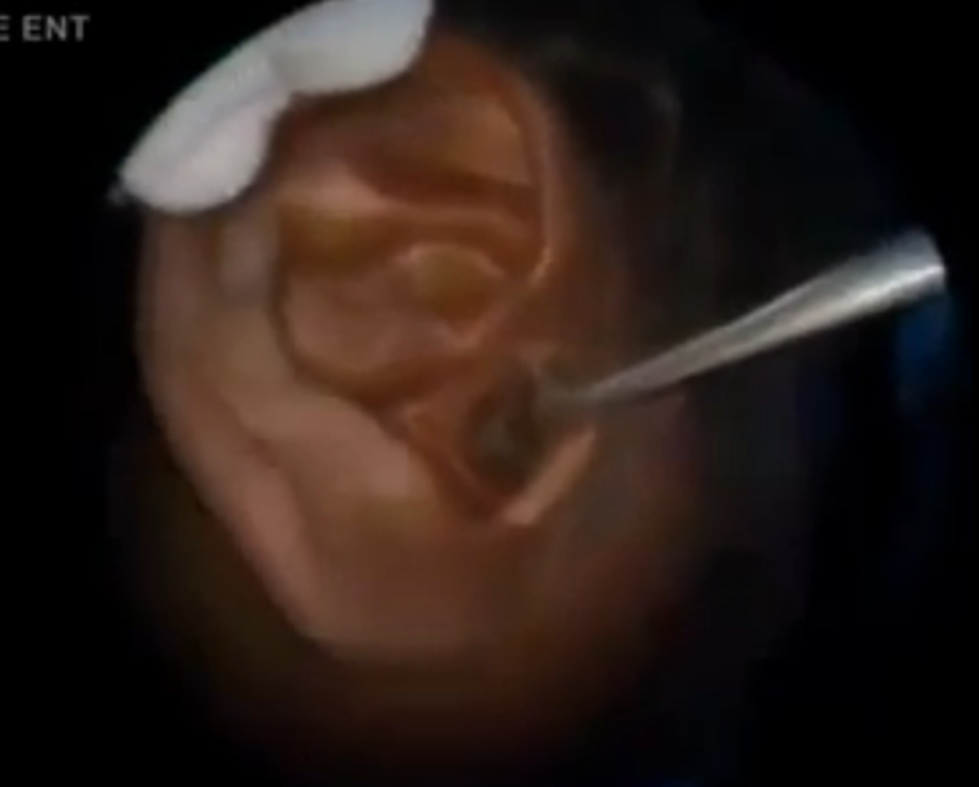 What Did This Doctor Pull Out Of a Man’s Ear?? [VIDEO]