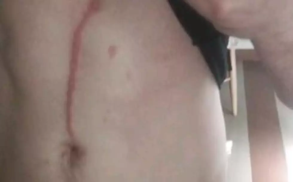 Spider Burrows Into Man&#8217;s Appendectomy Scar [VIDEO]