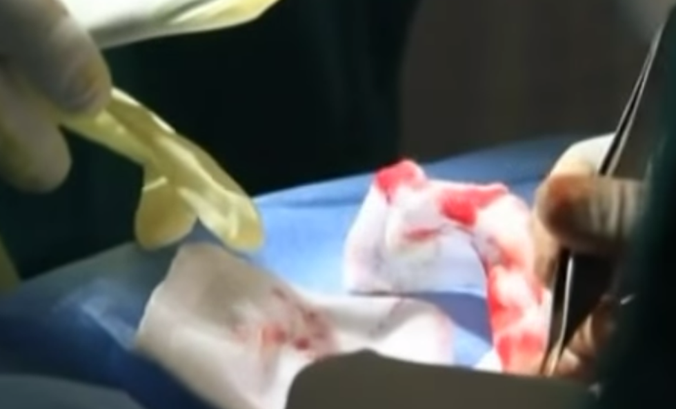 Doctors Perform World’s First Successful Penis Transplant [VIDEO]