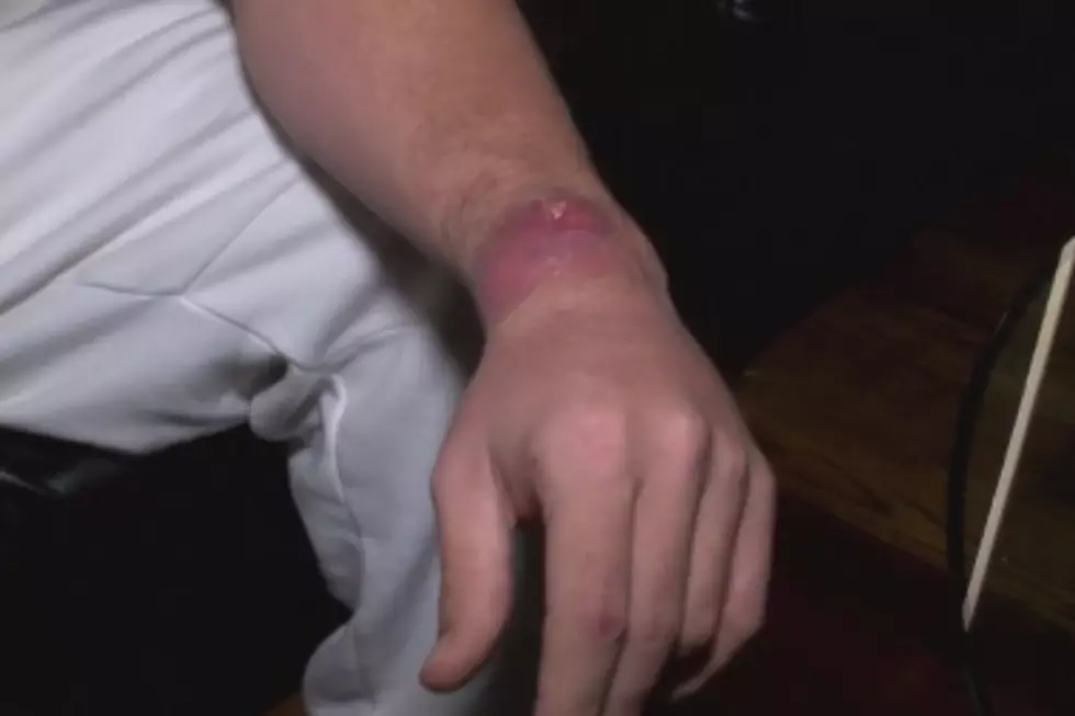 Saginaw Man Claims to Have Been Bitten by Brown Recluse Spider [VIDEO]