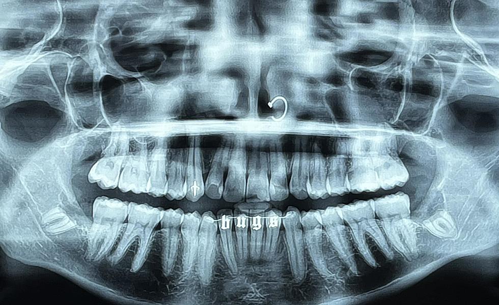 This Massachusetts Man Has 8 Wisdom Teeth, Here&#8217;s Just How Rare That Is