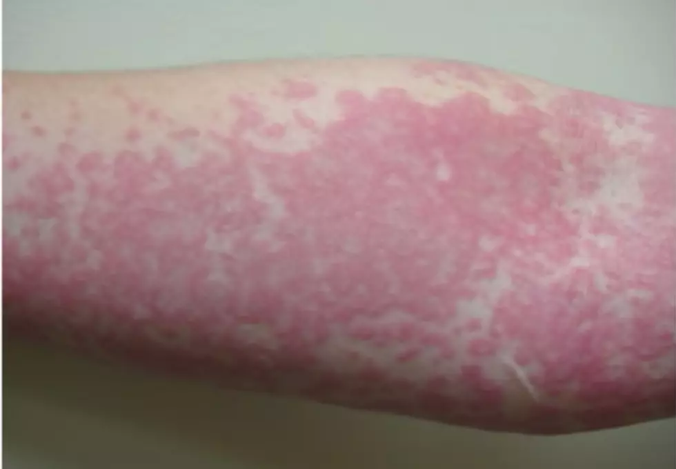 Have You Ever Gotten A Rash From The Sun? You Might Be Allergic