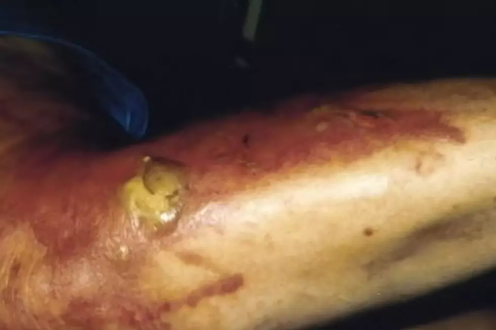 A severe burn on a man's arm caused by exposure to giant hogweed