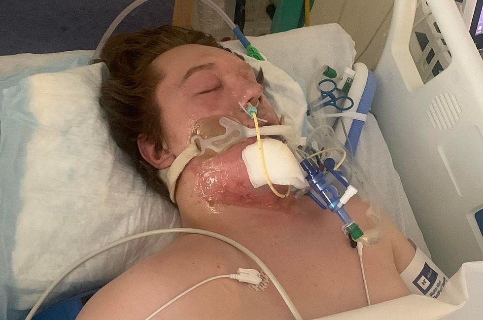 Over $40K Raised For Casper Teens Injured in Flash Fire