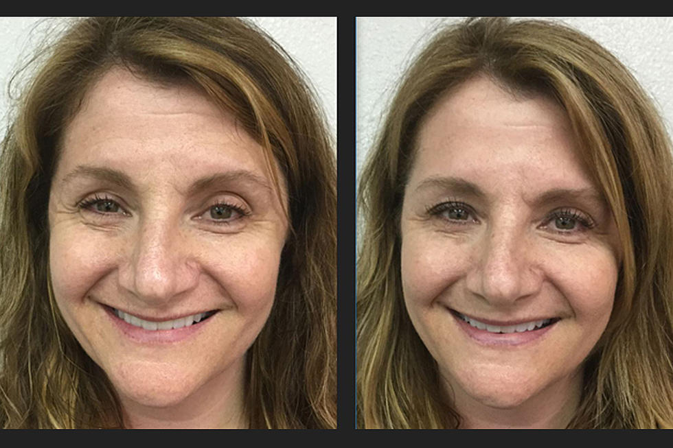 A Vampire Facelift Gave Me a Fresh Look Before A BIG Birthday