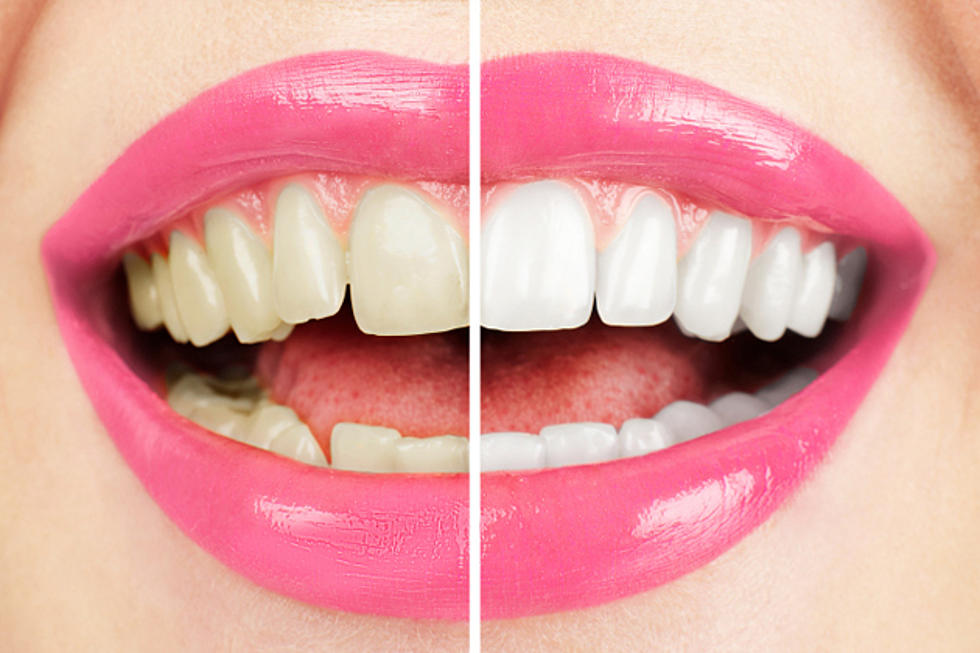 The Truth Behind Dental Bleaching and Teeth Whitening [FAQ]
