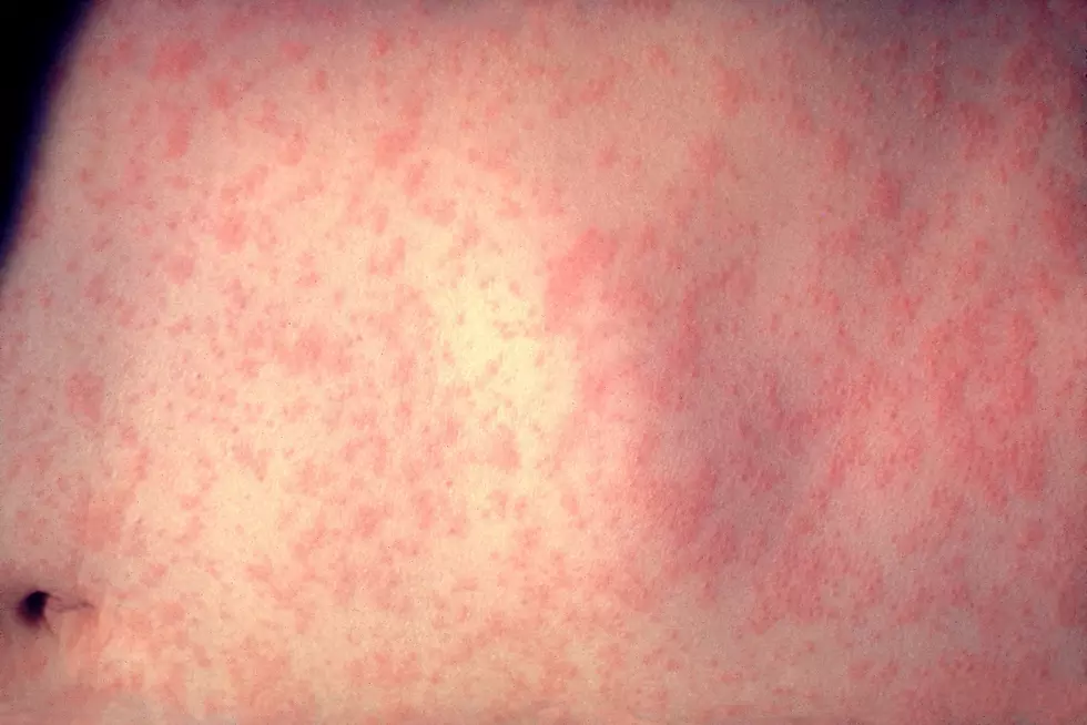 No Measles In Montana&#8230;Yet