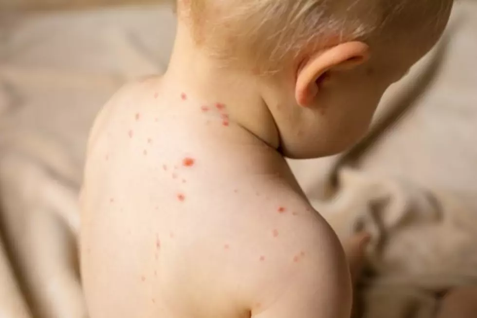 Chickenpox Confirmed in Grant County