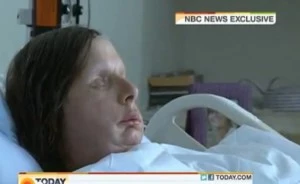 woman face transplant after chimpanzee attack