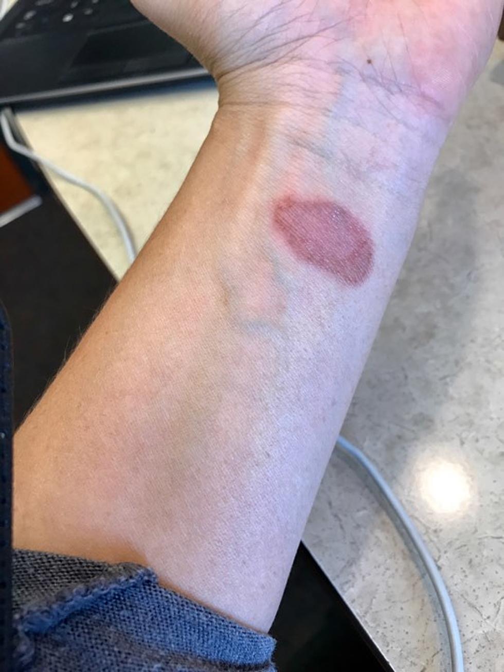 Beauty Pains, Burning Yourself With a Curling Iron Stories