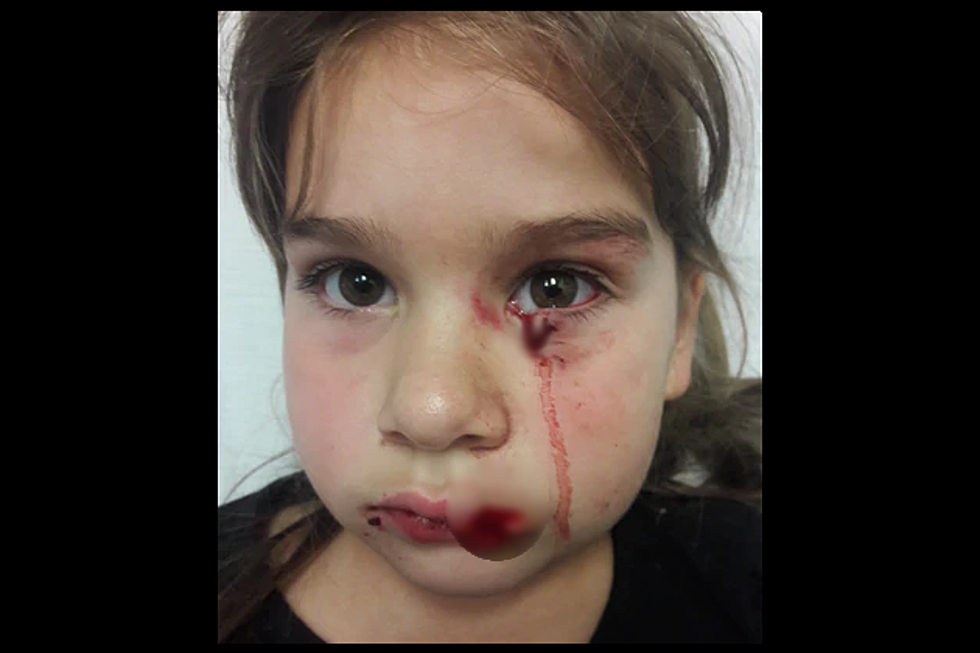 Young Girl Mauled By Emotional Support Pit Bull at Portland Airport! Family Sues