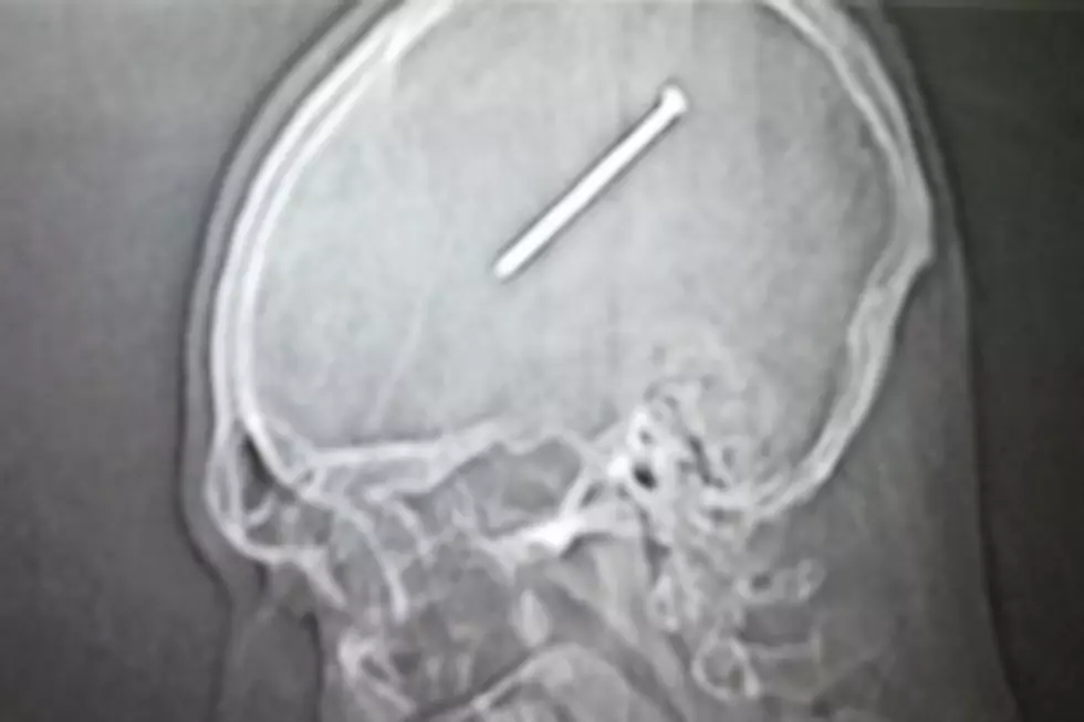 Man Doesn’t Notice He Shot a Nail Into His Skull