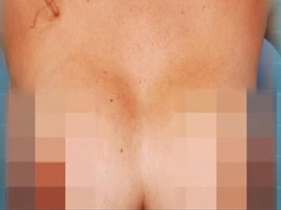 Botched Plastic Surgery Leaves Woman With ‘Uniboob’