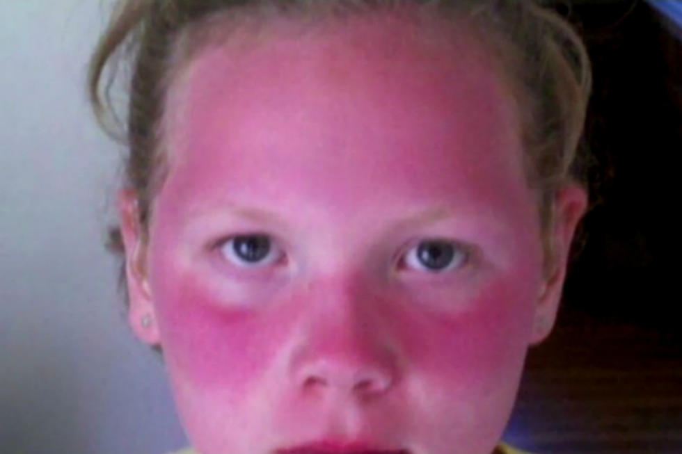 School’s Sunscreen Ban Leaves Students Severely Burned