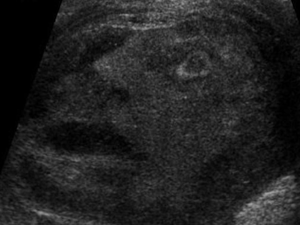 Screaming Face Discovered In Ultrasound of Testicular Tumor [PHOTO]