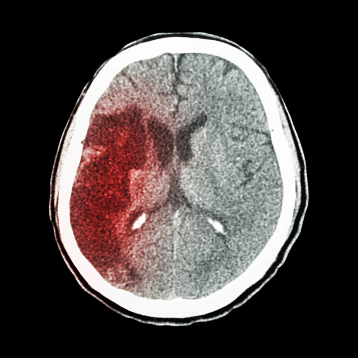 Кровоизлияние мозга снимок