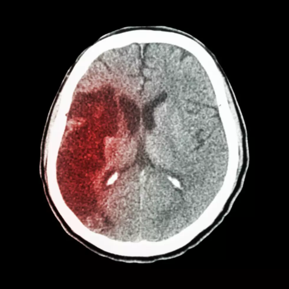 Heads Up East Texas: Know The Signs Of A Stroke