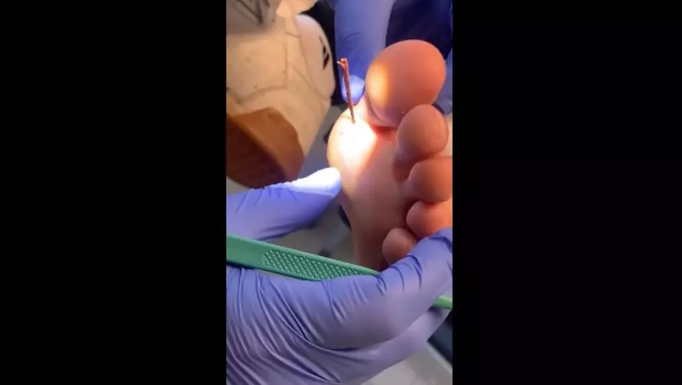 [NSFW] Watch as This GIGANTIC Splinter is Popped Out of a Foot, Oddly Satisfying