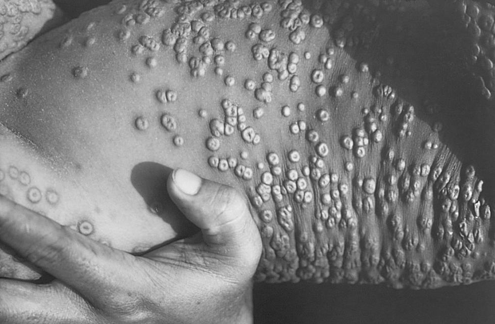 If COVID-19 Looked Like Smallpox, Would You Get Vaccinated?