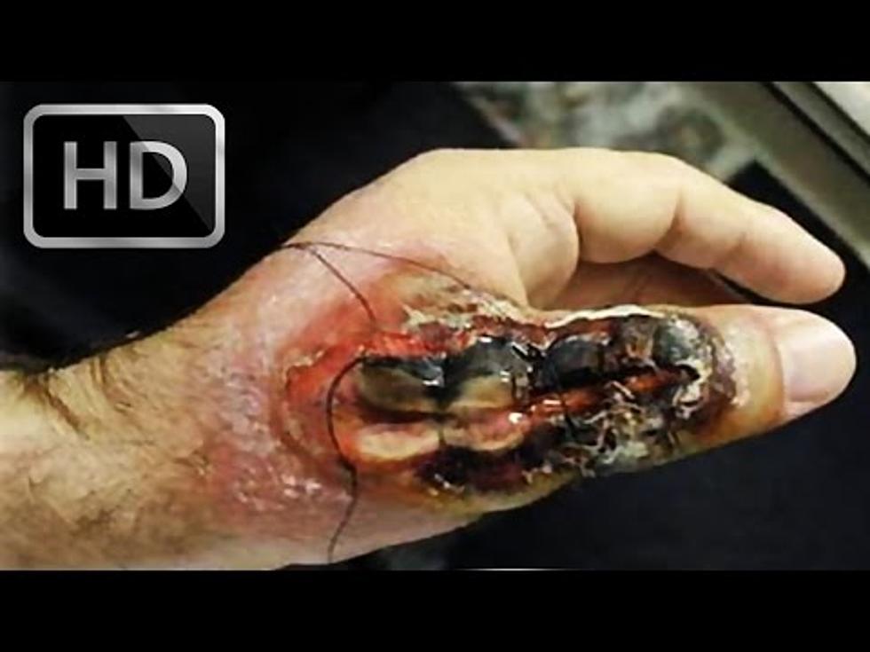 Gross! World&#8217;s Worst Spider Bite [NSFW] [VIDEO]