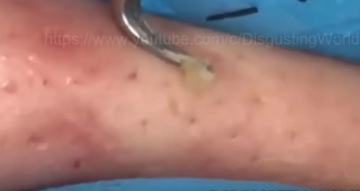 WATCH: This Blackhead Remover Can Squeeze Them So Quick [VIDEO]