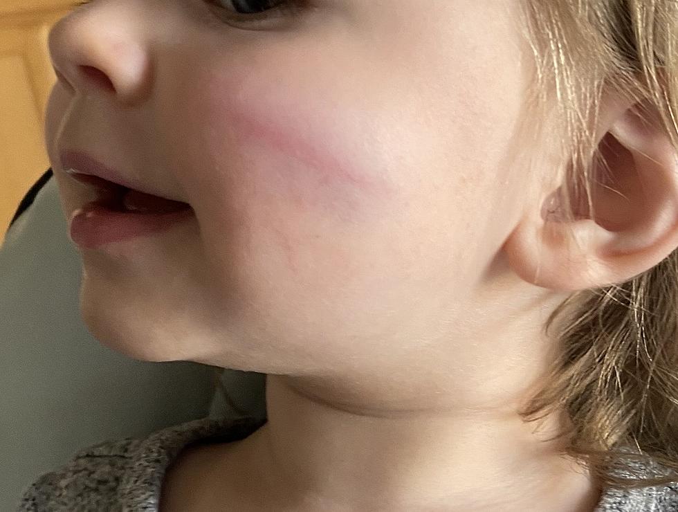 Toddler&#8217;s Unusual Bruise Looks Like a Buffalo Bills Logo