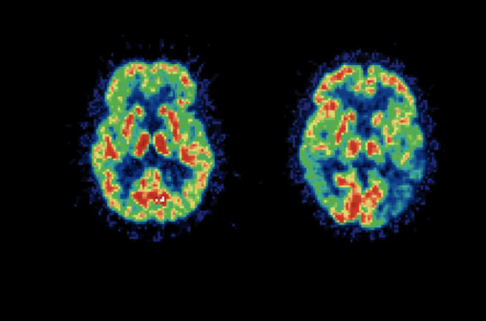 Brain-Imaging Technique Could Predict Cognitive Decline Over Time