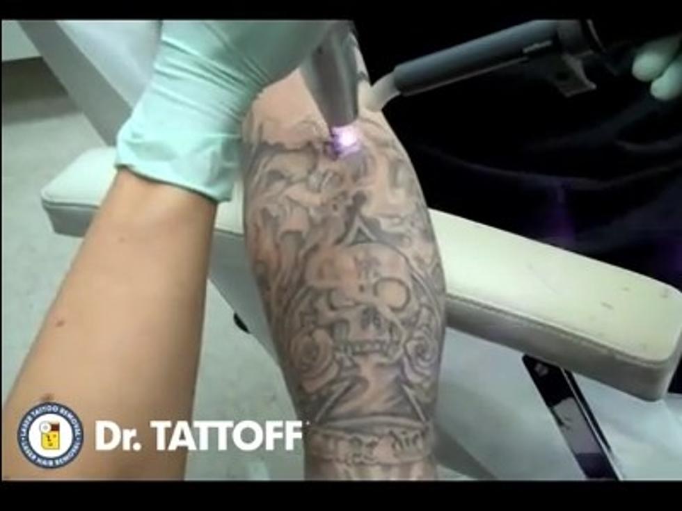 Tattoo Removal — With Lasers! [VIDEO]