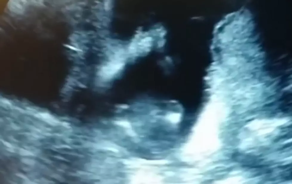 Baby Clapping in an Ultrasound [VIDEO]