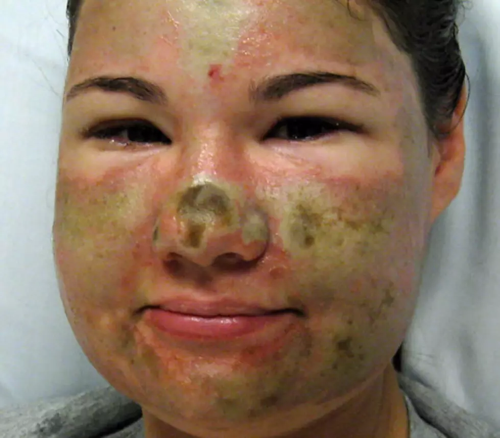 Woman Destroys Face With Acid, Blames Black Woman