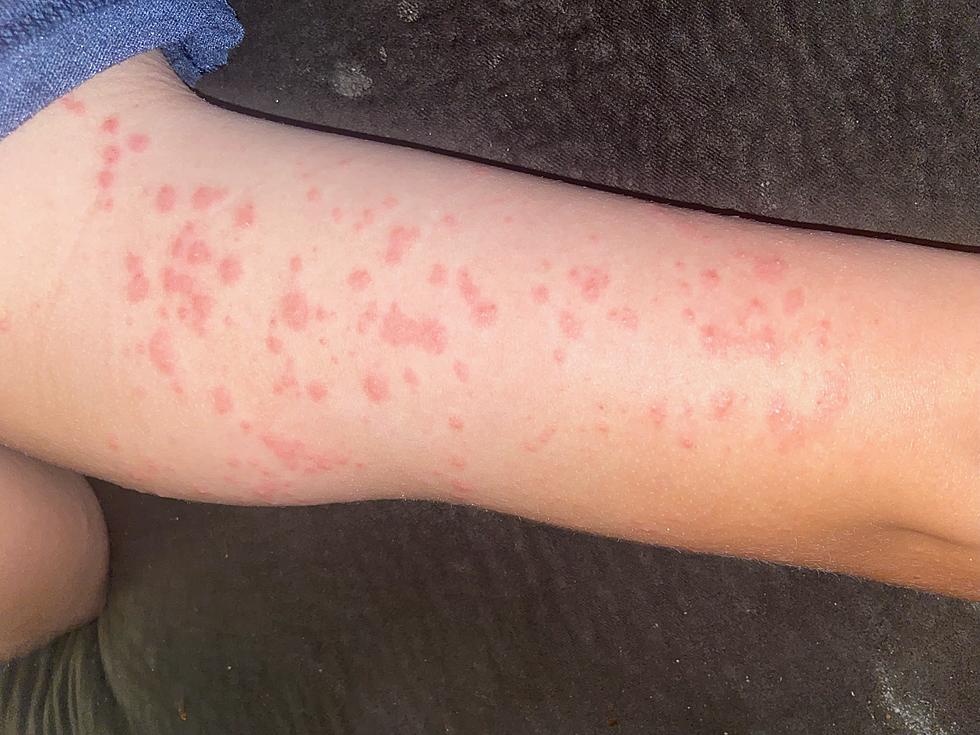 Is Scarlet Fever The Surprise Illness Of 2023 In Amarillo?
