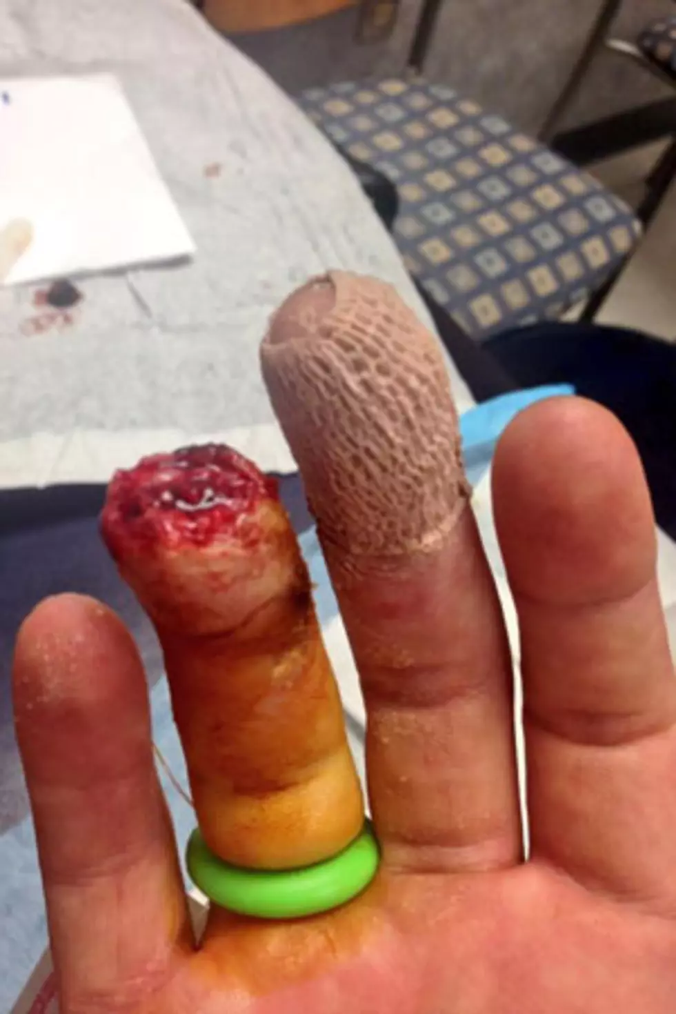Jake Owen Shares Gruesome Photo of Severed Finger [NSFW]