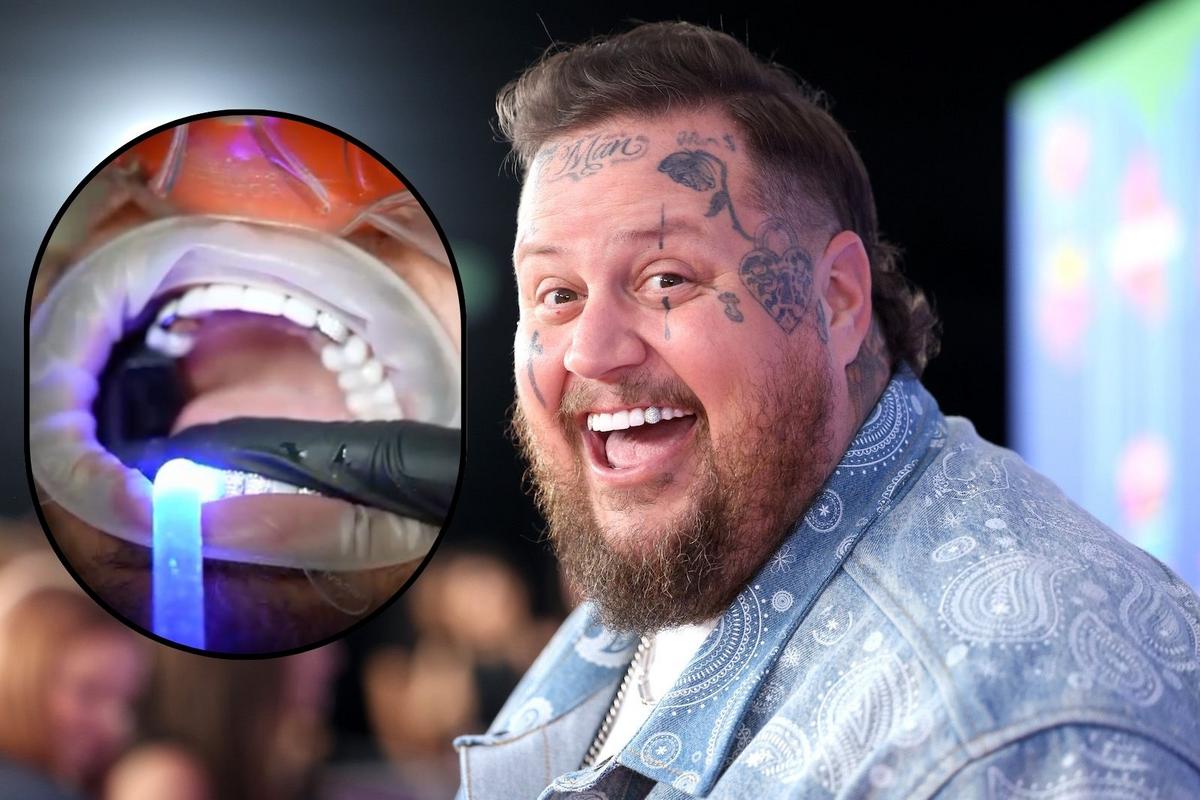 Watch Jelly Roll’s Teeth Transformation — As Seen by His Dentist!