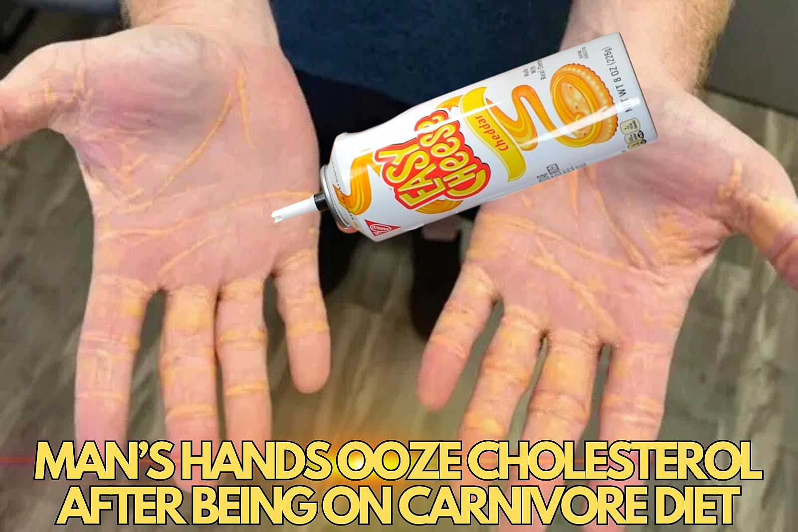 Man’s Hand Ooze Cholesterol Due to Popular Carnivore Diet