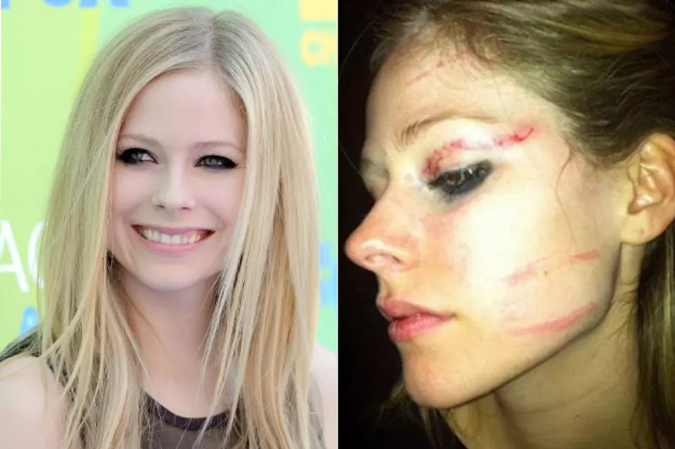 Avril Shares Pic of Bruised Face From Fight
