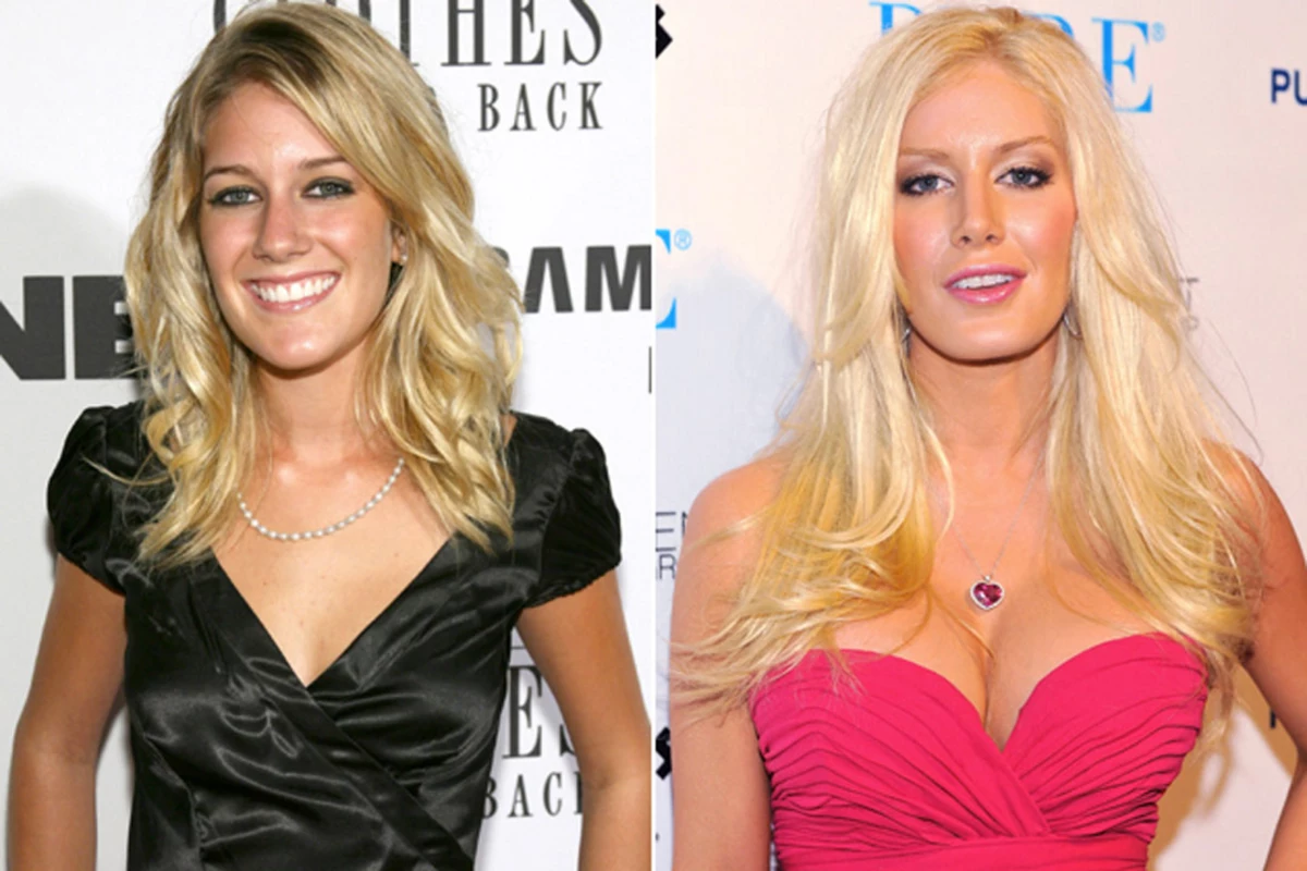 Celebrities' Plastic Surgery: See Before and After Photos
