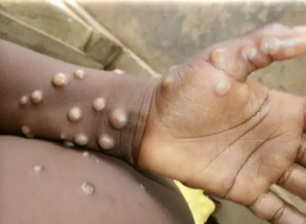 Monkeypox—Now in 12 Countries