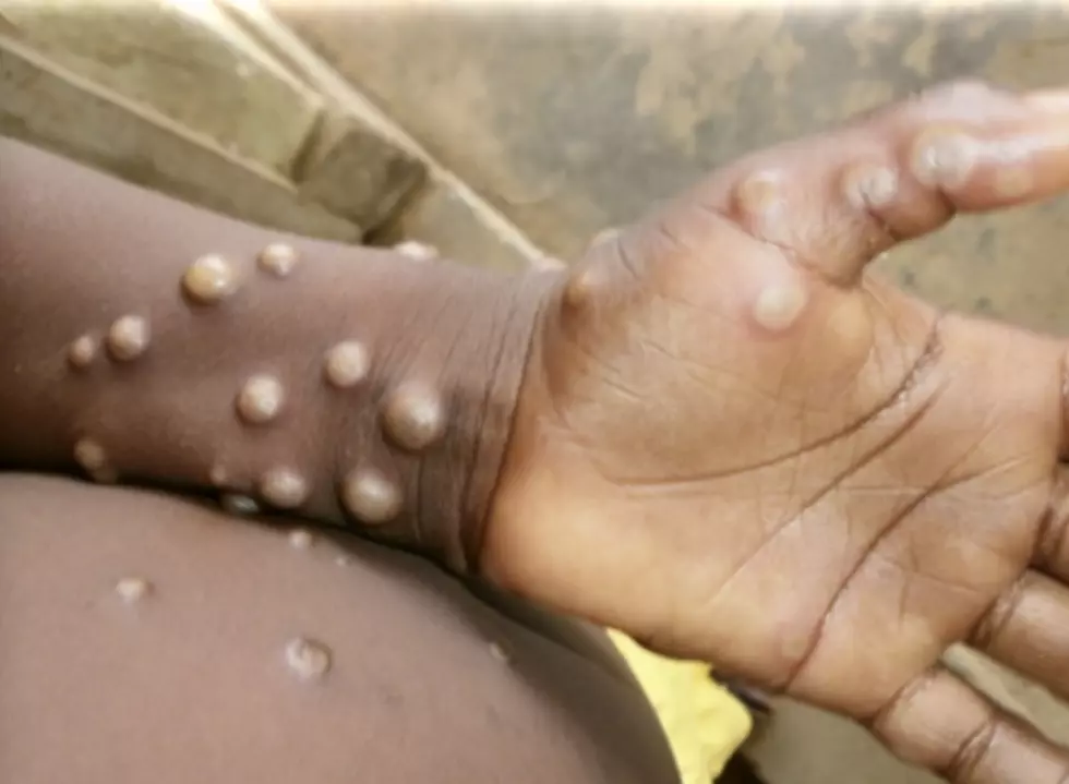 Monkeypox—Now in 12 Countries 