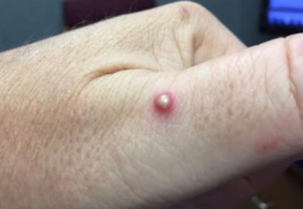 The Ant Bite - To Pop Or Not Pop, That Is The Question