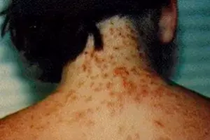 Attention Beach Goers &#8211; Sea Lice Are A Real Thing