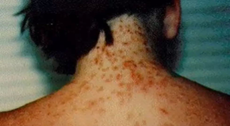 Here's What You Should Do If You're Exposed To Sea Lice