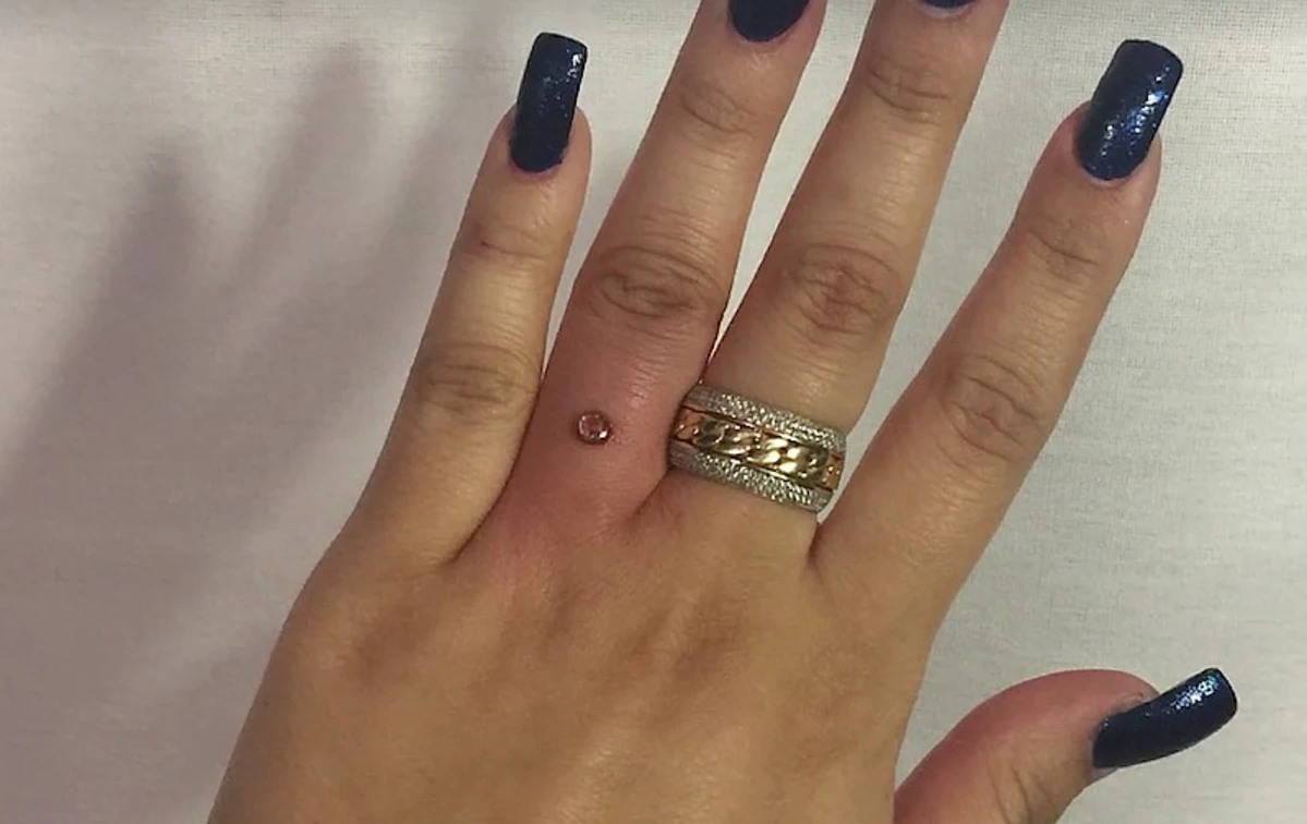 Engagement Trend 'Finger Piercing' Takes Place Of A Ring [Video]
