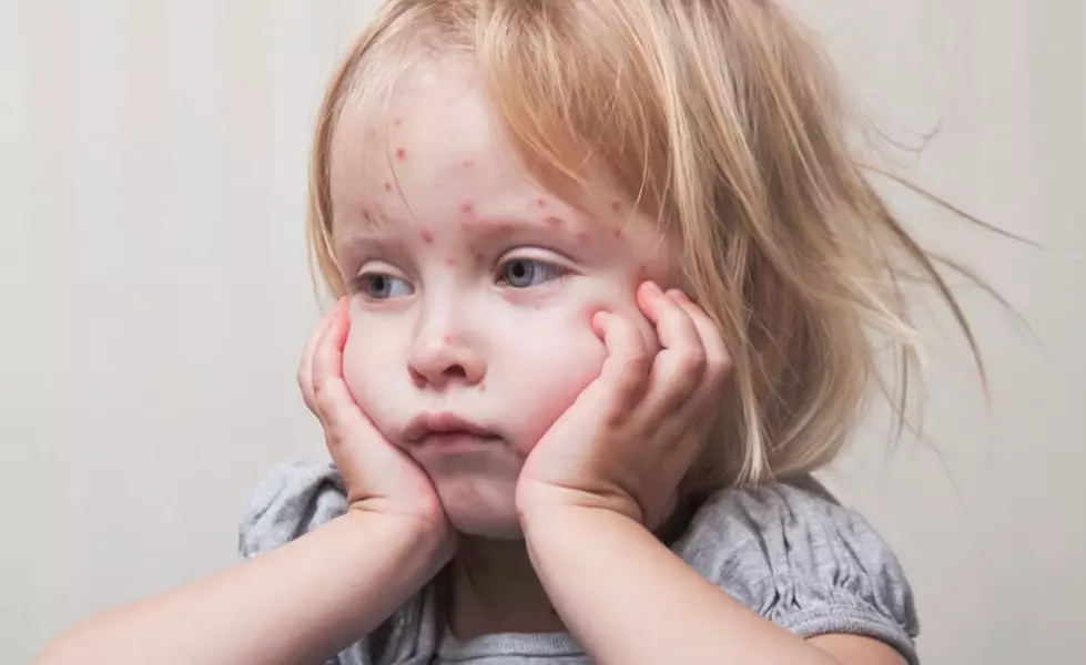 Do You Need A Measles Booster Shot? You Probably Do