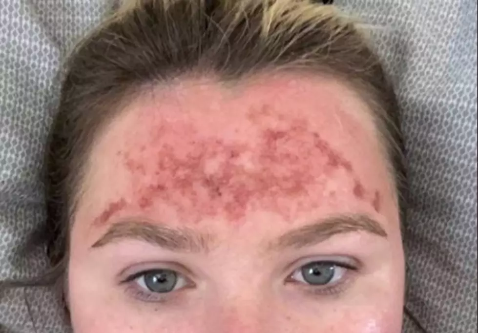 Woman Claims Expired Sunscreen Caused 2nd Degree Burns